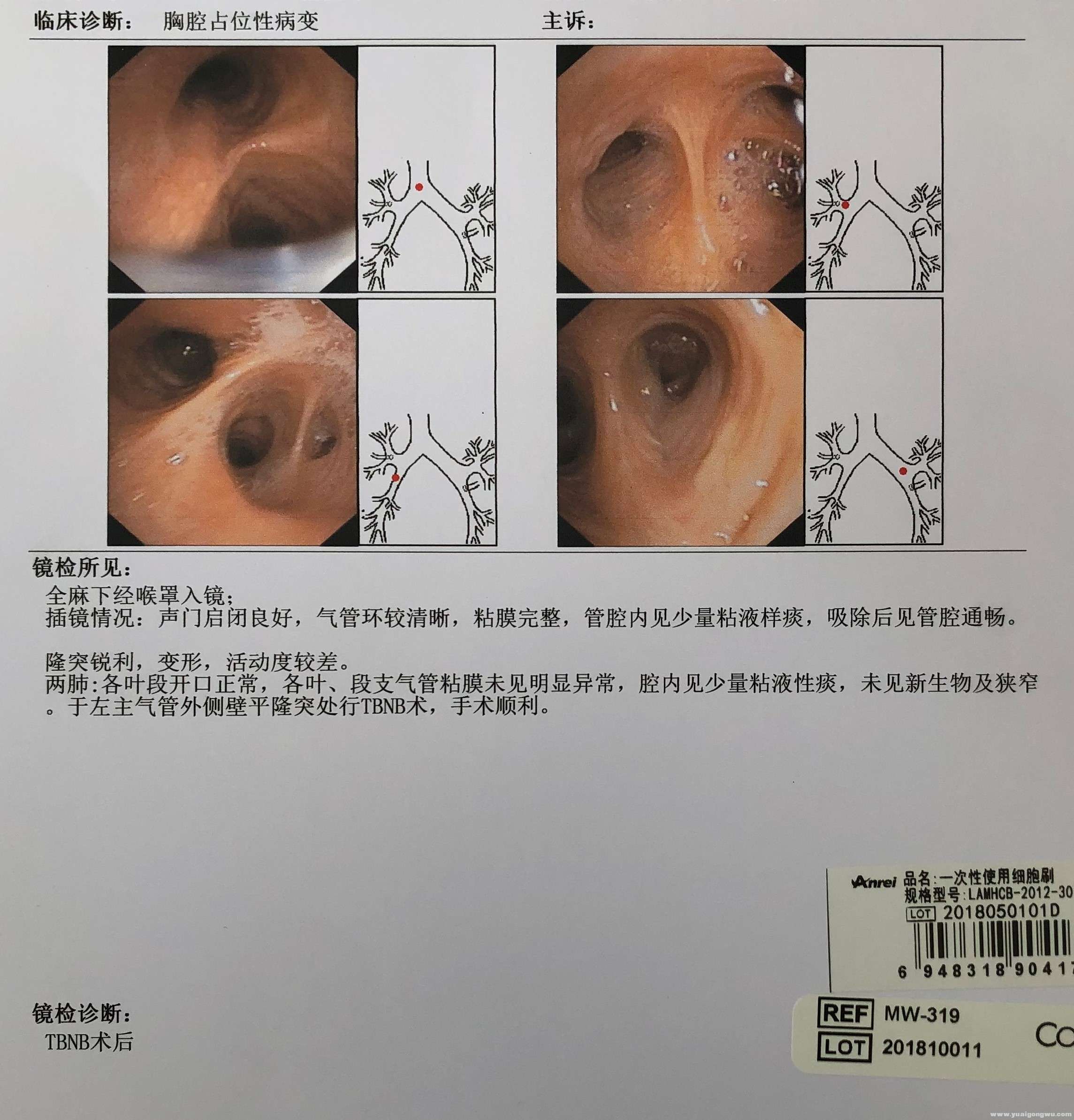 支气管镜肺癌报告图片图片